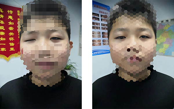 盈目义眼成功案例