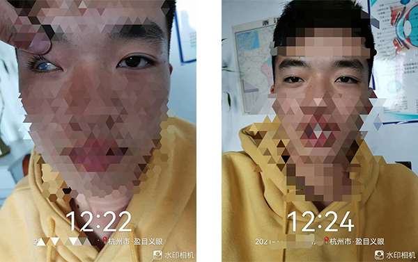 盈目义眼成功案例