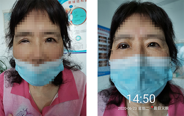 盈目义眼成功案例