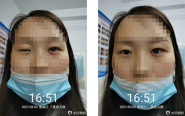 盈目义眼成功案例